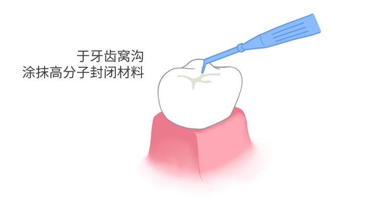 建议3~4岁可为乳磨牙,约12岁为双尖牙和第二恒磨牙进行窝沟封闭,部分