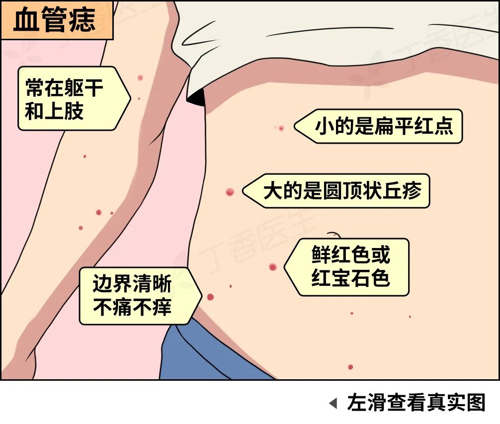 血管痣原因图片