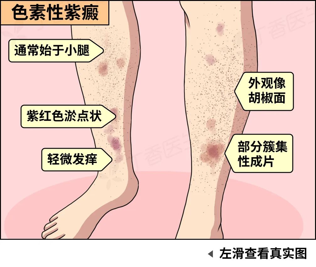 红蜘蛛皮肤病图片图片