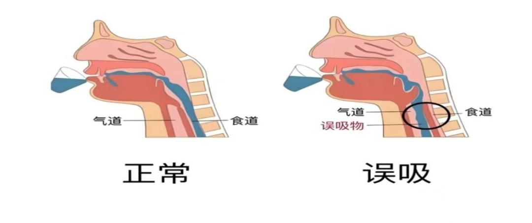 每次进食期间的观察,防止误吸特别是隐性误吸发生;2)运用吞咽功能训练