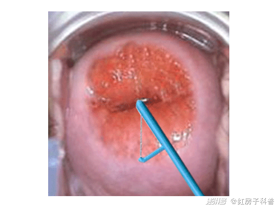 leep刀后宫颈图片图片