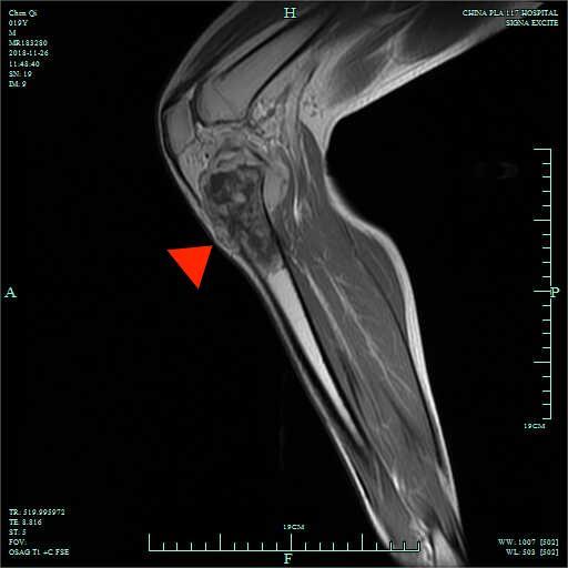 骨肉瘤发病率男性略高于女性,多发于远端股骨,近端胫骨和肱骨等长骨