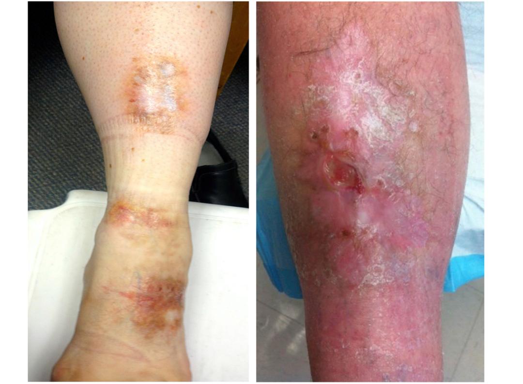 01 病理表现为累及真皮并扩展至皮下组织的栅栏状或间质性肉芽肿性