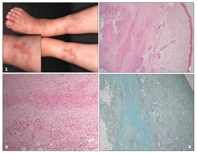 医声医识丨有"裸结节"的都是结节病吗?