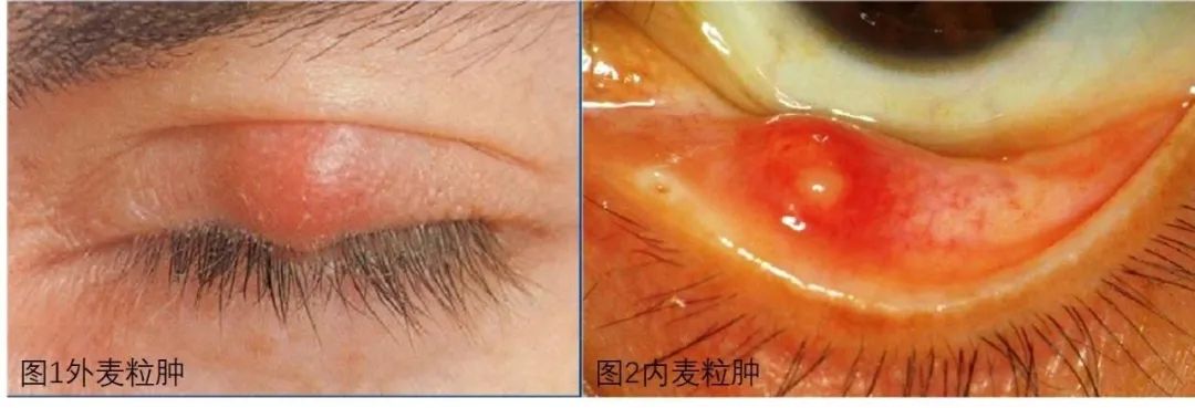 急性麦粒肿是夏季的高发眼病,在儿童中尤为常见,经常化眼妆者以及共用