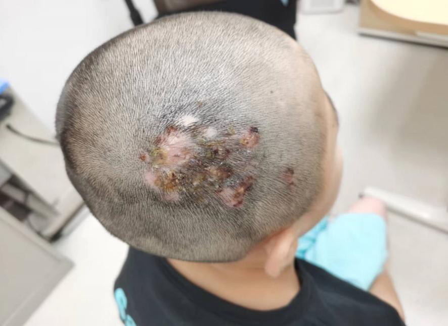 养猫家庭注意,如何预防和治疗儿童头癣?