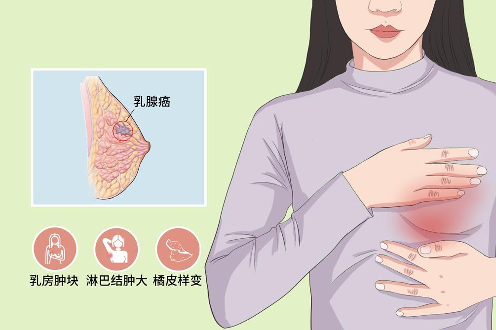 乳腺癌位置图图片