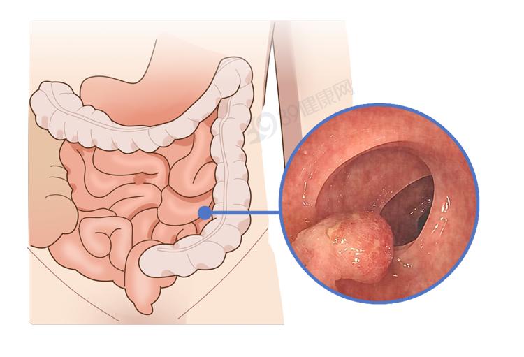 肠癌都是拖出来的?肠道发现这3种息肉