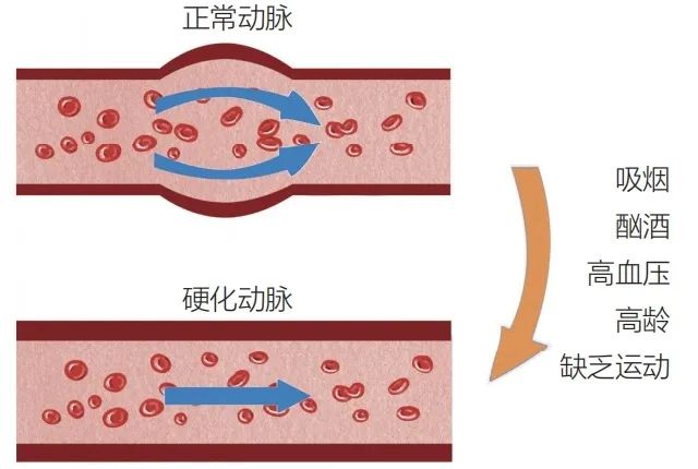 年龄60岁,血管80岁?揭开血管早衰的秘密
