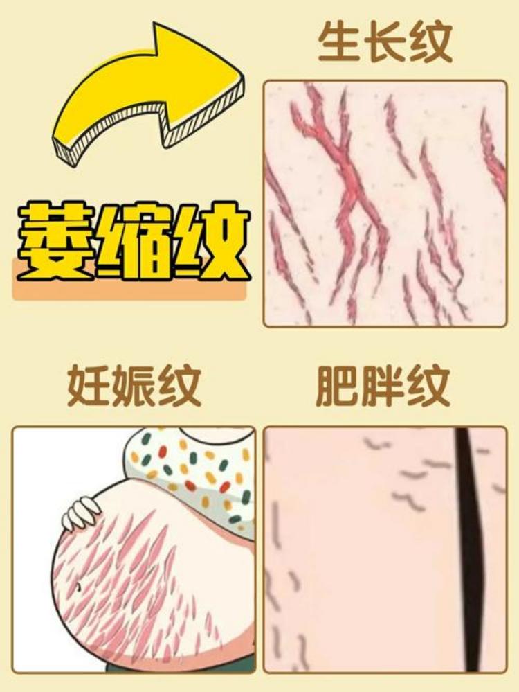 萎缩纹的前世今生