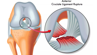 断裂的韧带与不屈的精神-关于自体、异体、人工韧带你想知道的那些事