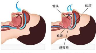 困擾著1億多中國人！奧運冠軍自曝40歲就佩戴呼吸機睡覺