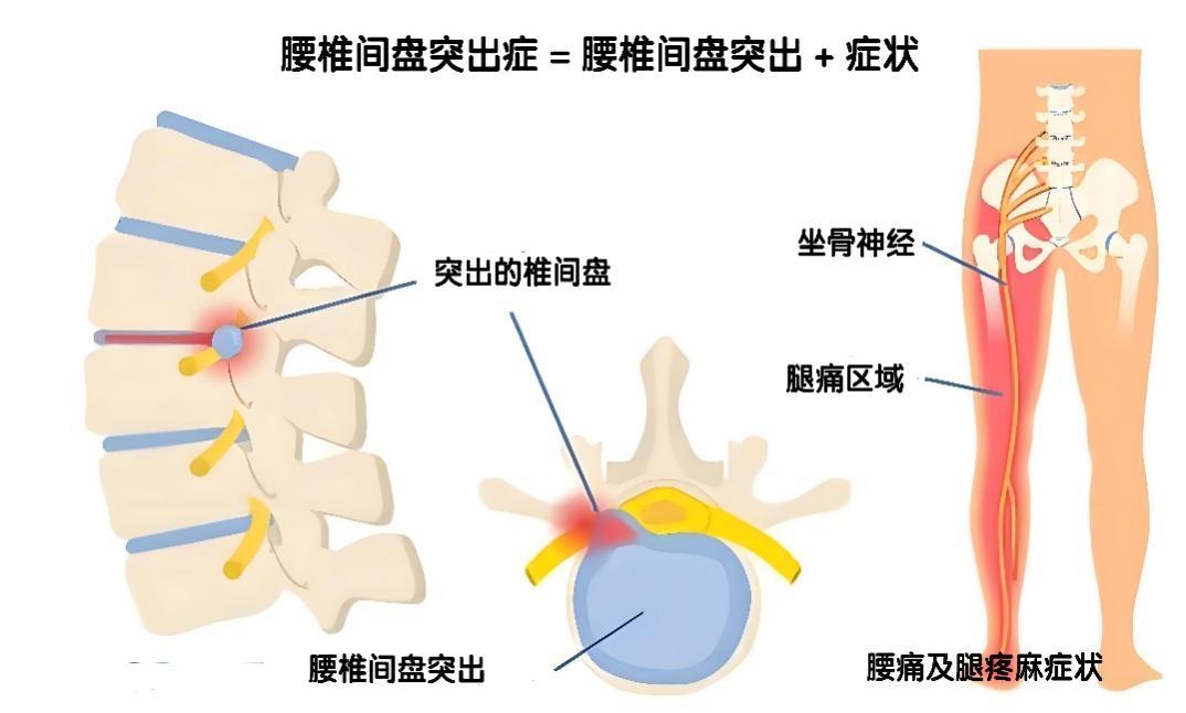 正常腰椎间盘图片