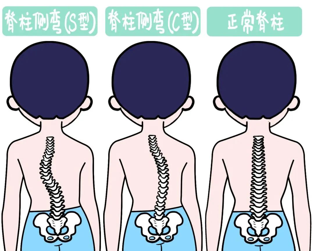 脊柱弯曲异常是指脊柱弯曲形态超出了正常生理弯曲范围