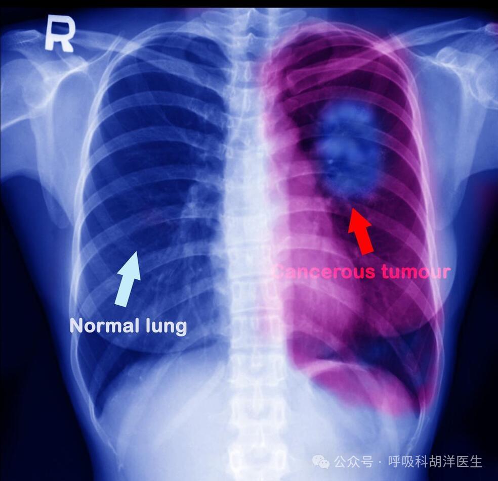 肺癌x光片图片早期图片