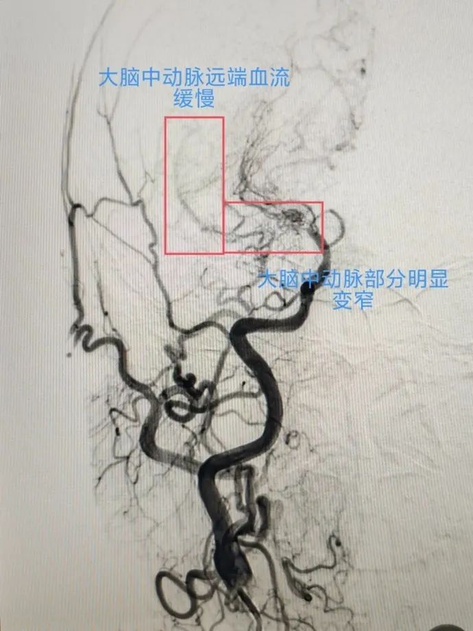 脑血管球囊扩张术图片