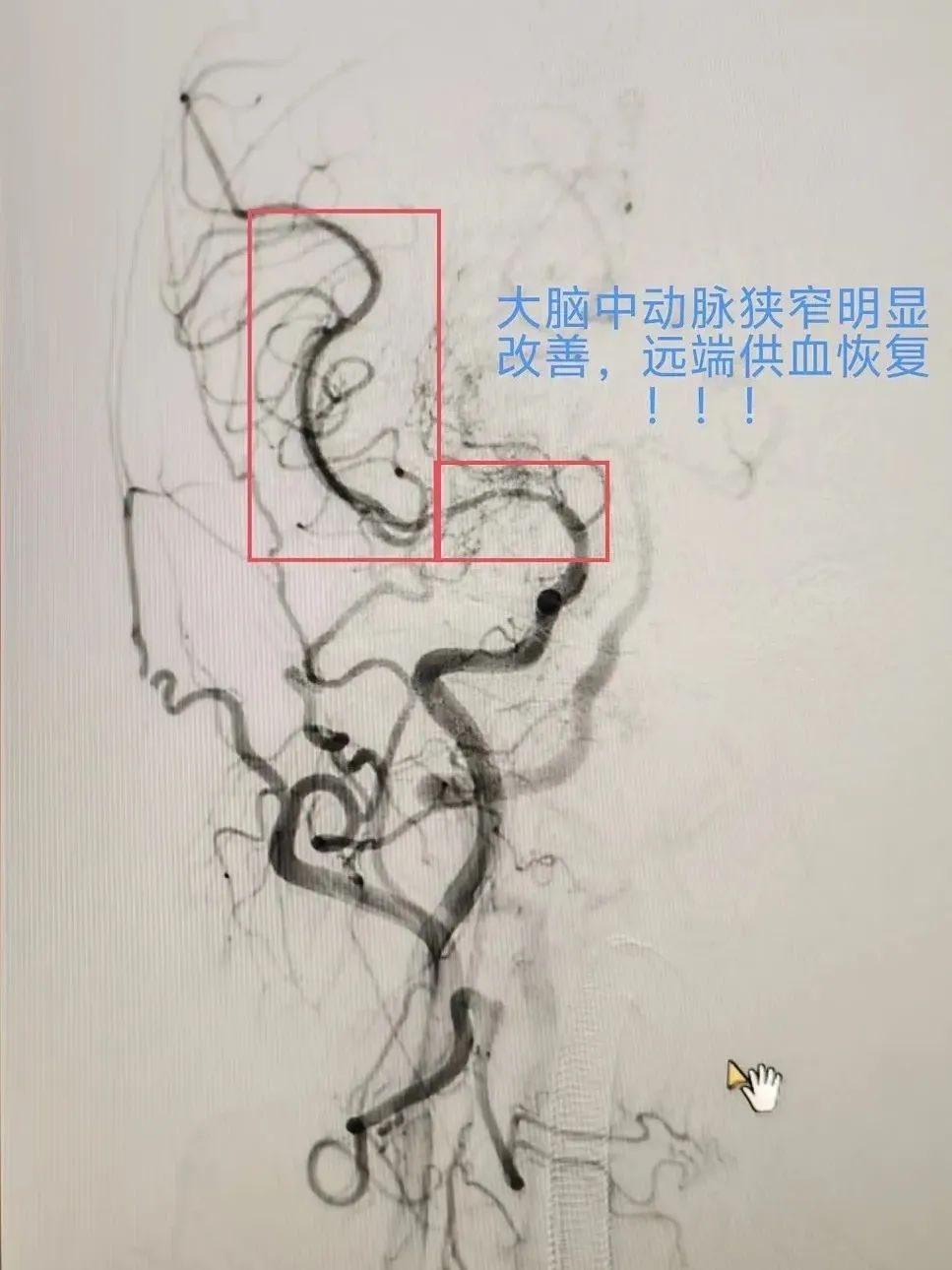 脑血管球囊扩张术图片