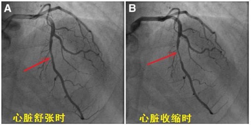 心肌桥该怎么治疗那心肌桥该怎么治疗呢?