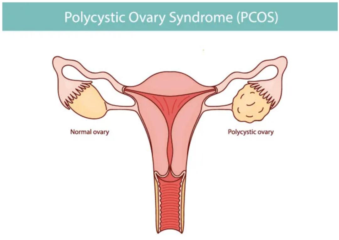 关于青春期多囊卵巢综合征，这些事情您可能还不知道？  第1张