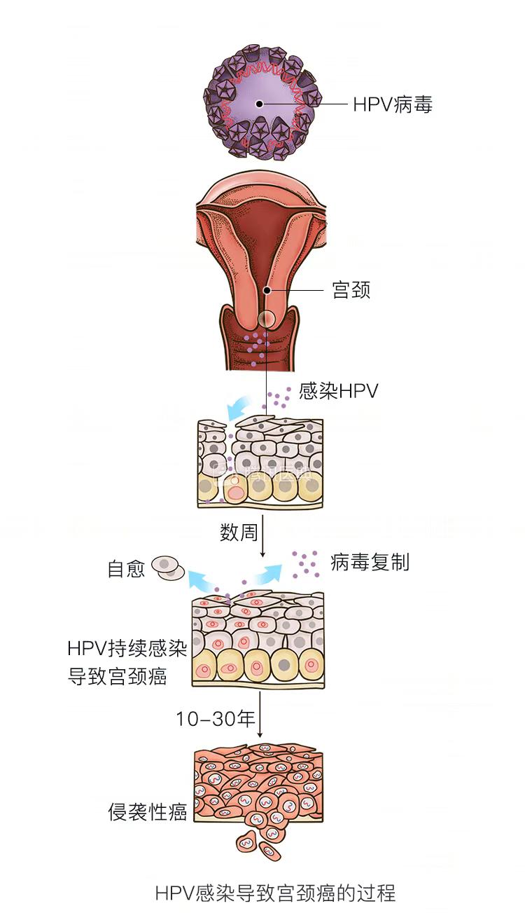 淋病女性妇科图片