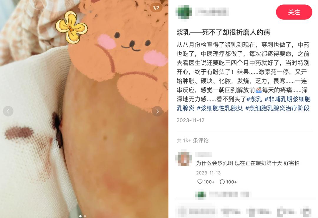 浆乳肉芽肿性乳腺炎图片