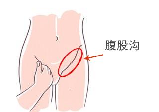 腹股沟黑色素图片图片