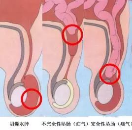 小肠疝气位置图片图片