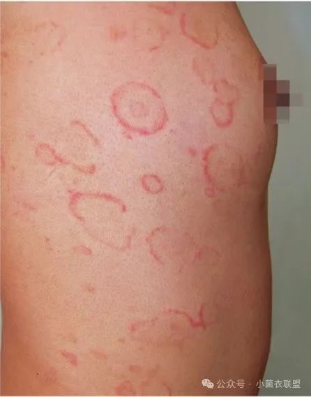 亚急性皮肤型红斑狼疮:表现为曝光部位呈环状浮肿性浸润性红斑鳞屑性