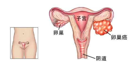 我还是建议患者考虑切除对侧的卵巢和子宫,毕竟不算是属于可以保留