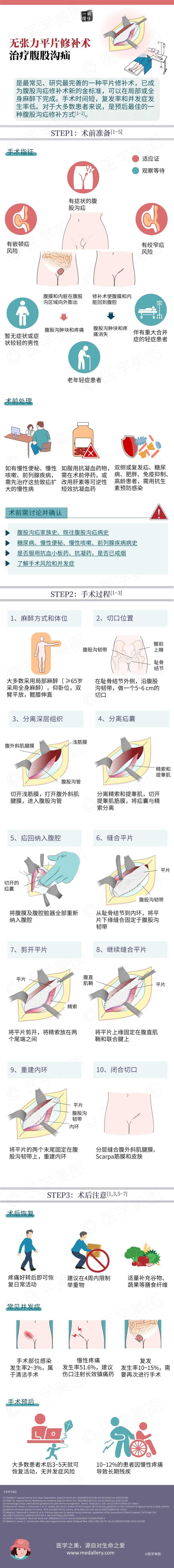 简单三步丨无张力平片修补术治疗腹股沟疝