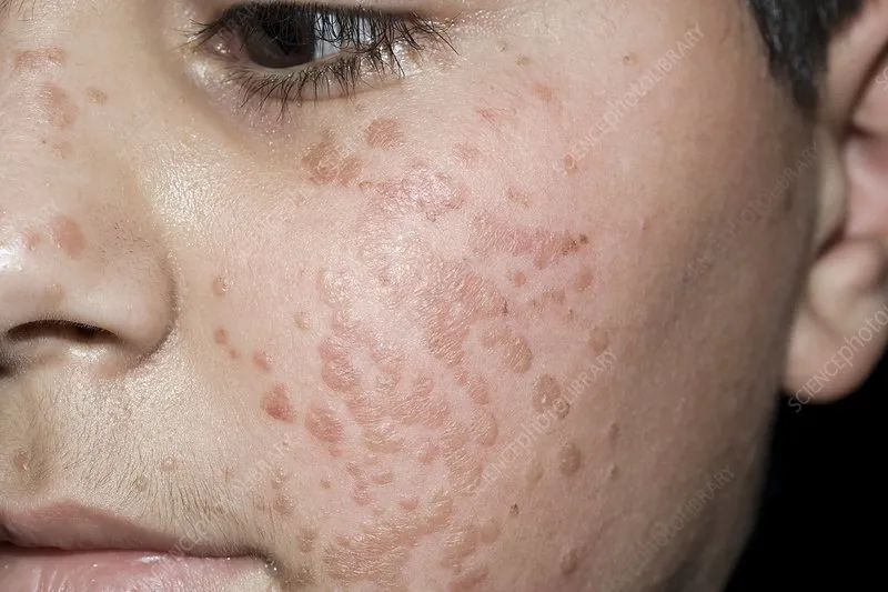 身上这4种肉疙瘩,可能和hpv感染有关