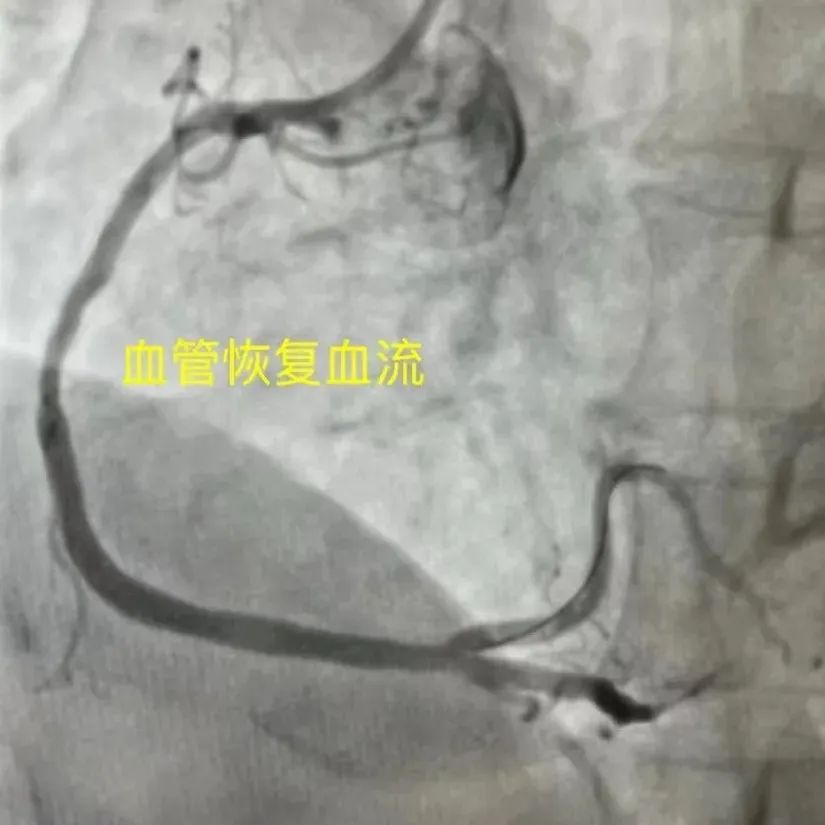 同心医+｜中国1120心梗救治日——普陀区人民医院成功救治“二次”心梗患者