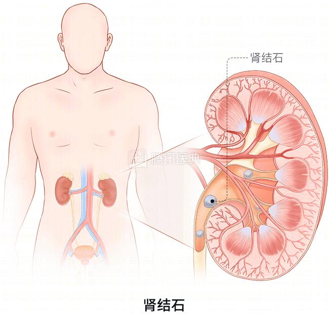 肾下极位置图图片