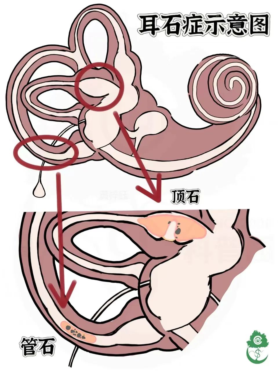 —老年综合征之眩晕:5秒钟测一测你是耳石症吗