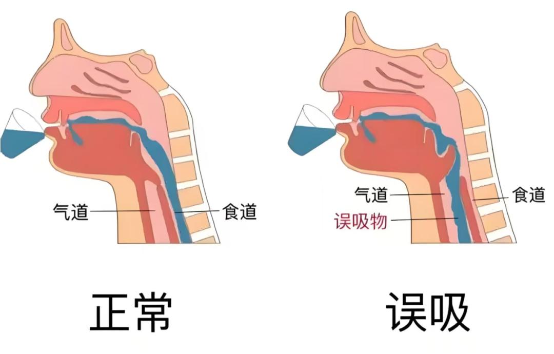 惊险!七旬老人误吸河虾窒息,医生救治及时化险为夷