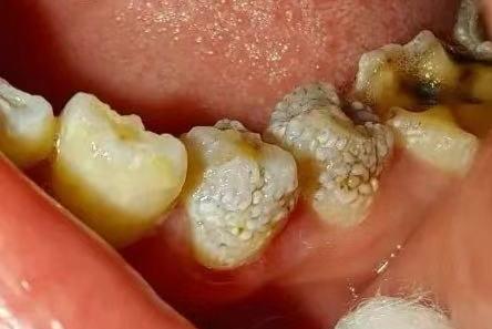 牙釉质发育不全:牙齿的"保护层"为何变脆弱?