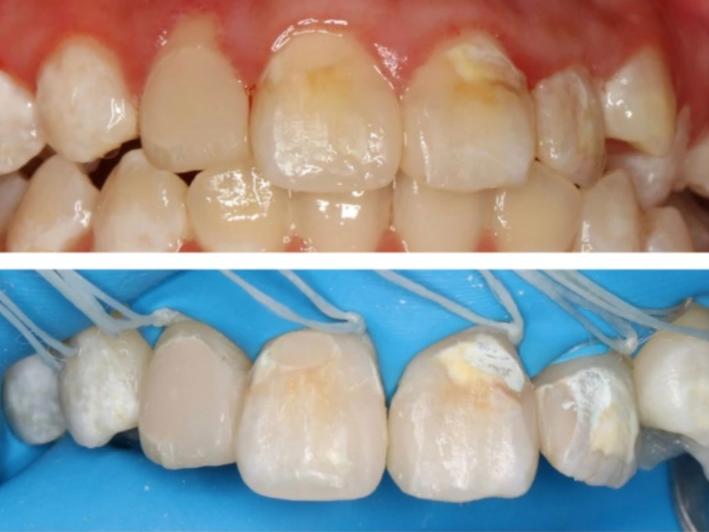 牙釉质发育不全:牙齿的"保护层"为何变脆弱?