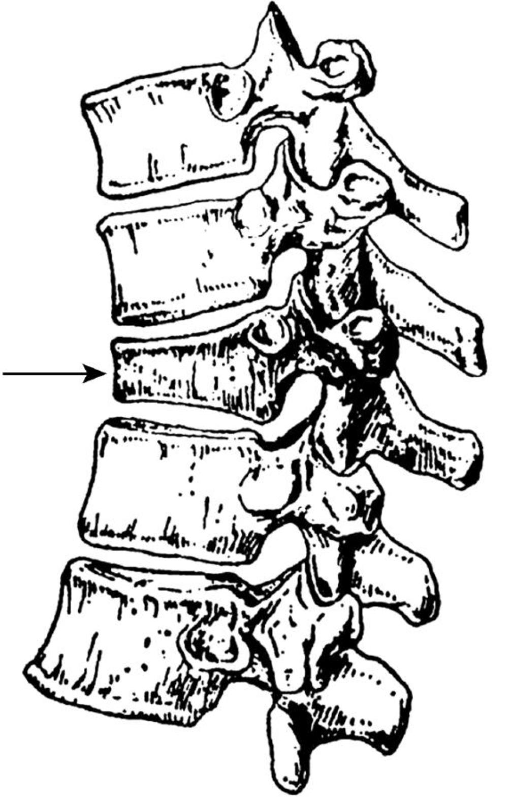 一女子滑了一下，轻轻坐地，竟然就腰椎骨折了！梅雨季，这类人一定要注意