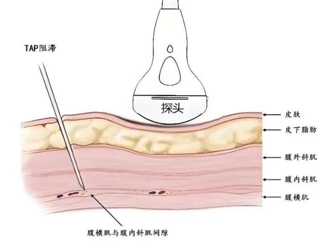 麻醉泵是什么不止镇痛泵！剖宫产术后还有这种镇痛“神器”_https://www.jmylbn.com_新闻资讯_第4张