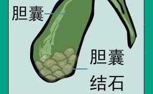 漫畫｜膽囊結石那么痛，究竟是怎么一回事？