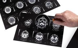 国际癫痫关爱日｜大脑“乱放电”，当心是肿瘤作祟