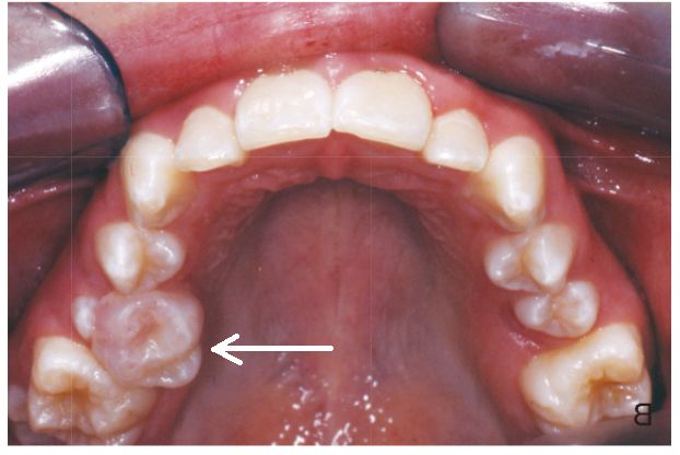 乳磨牙乳牙滞留是指新的恒牙已经萌出,而对应的乳牙尚未能脱落的情况