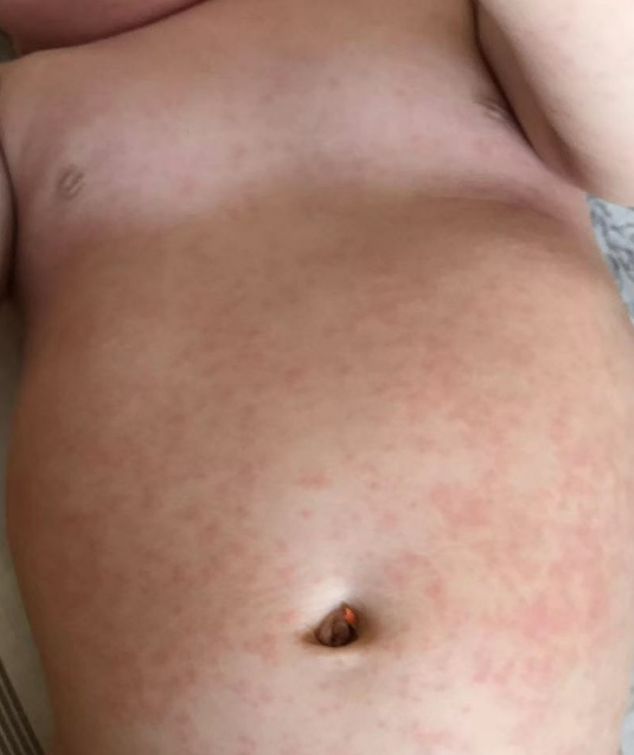 宝宝发烧后满身红疹是过敏了吗？别慌，可能是幼儿急疹 身体 澎湃新闻 the paper
