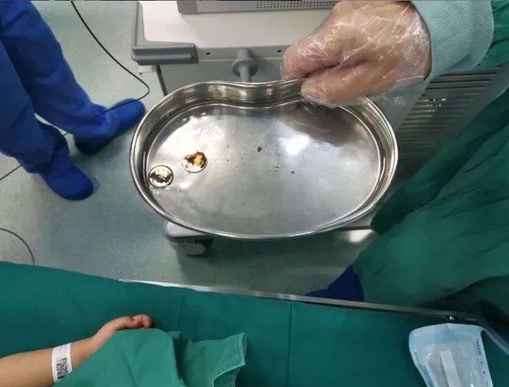 方案一定,手术团队立即邀请耳鼻喉头颈外科副主任医师闫小会前来帮忙