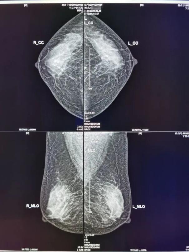 乳腺超声图片怎么看图片