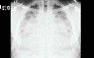 看不见的敌人：2001年已经有了双肺发白的病例？