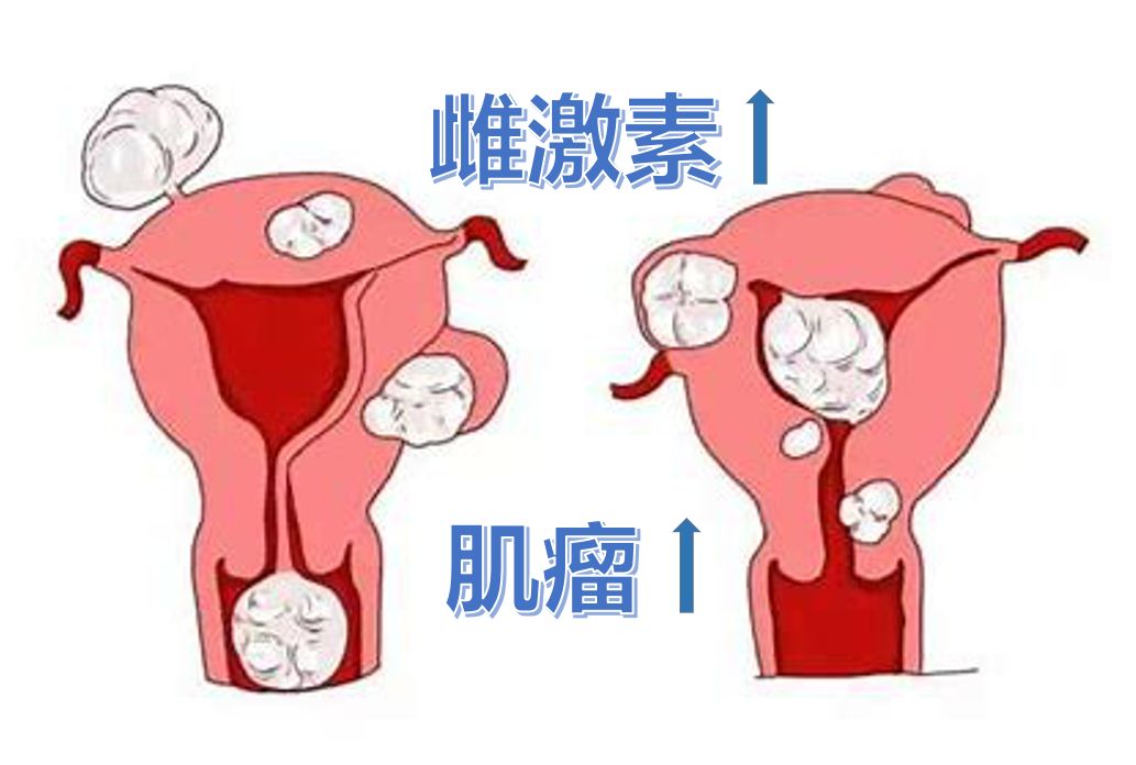 崔医生:确实是这样,因为你是女性,你有雌激素,子宫肌瘤的生长完全是一