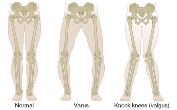 xo型腿骨骼拍片图解图片