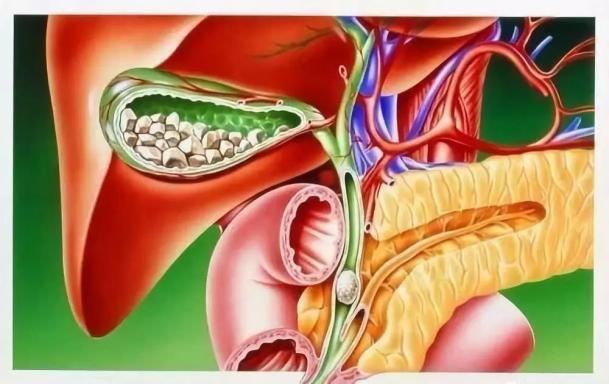 致死率极高的癌症 王中王 不是胰腺癌 湃客 澎湃新闻 The Paper