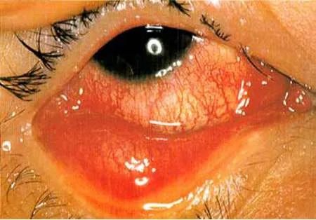 1988年7月下旬,北京市一些单位出现红眼病流行,到8月,显现出暴发流行